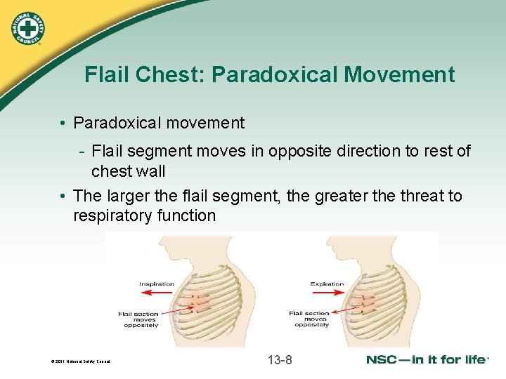 Flail Chest: Paradoxical Movement • Paradoxical movement - Flail segment moves in opposite direction