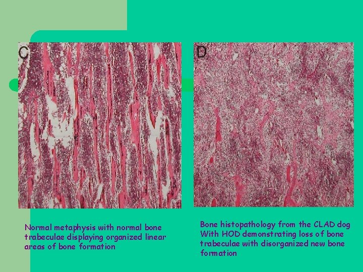 Normal metaphysis with normal bone trabeculae displaying organized linear areas of bone formation Bone