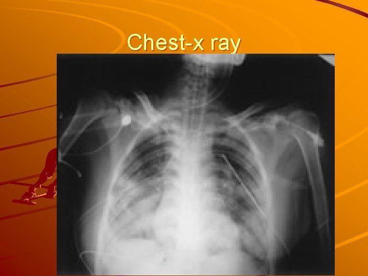 Chest-x ray 