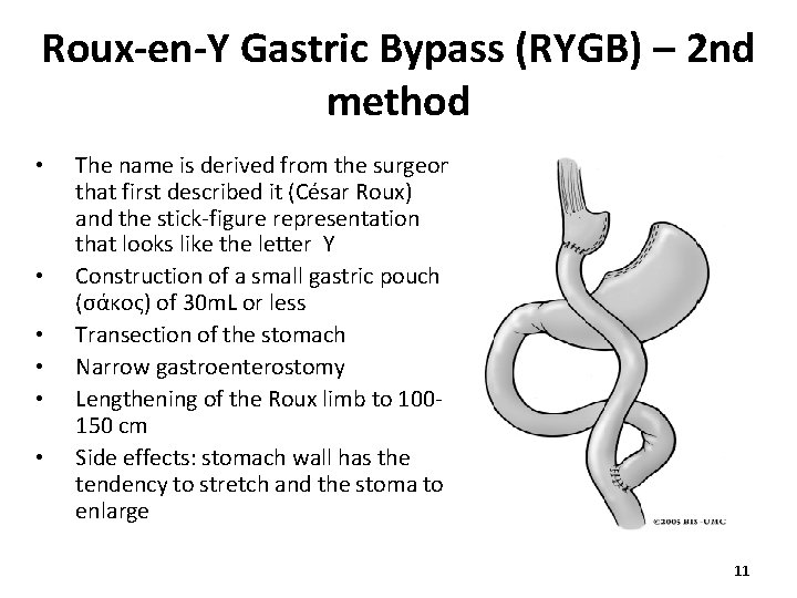 Roux-en-Y Gastric Bypass (RYGB) – 2 nd method • • • The name is