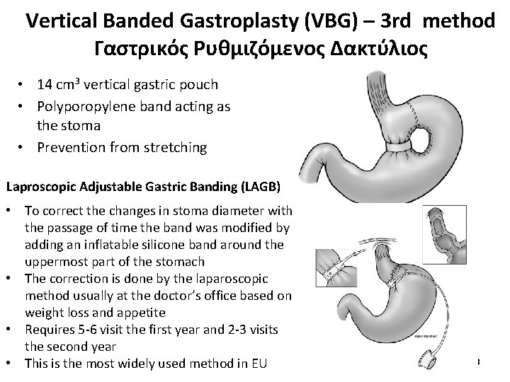 Vertical Banded Gastroplasty (VBG) – 3 rd method Γαστρικός Ρυθμιζόμενος Δακτύλιος • 14 cm