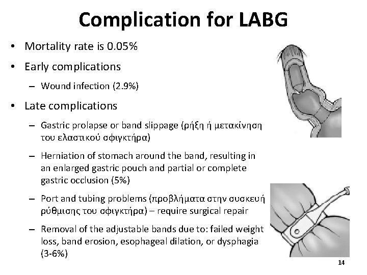 Complication for LABG • Mortality rate is 0. 05% • Early complications – Wound
