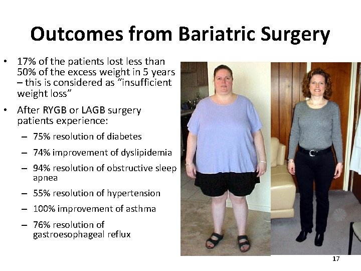 Outcomes from Bariatric Surgery • 17% of the patients lost less than 50% of