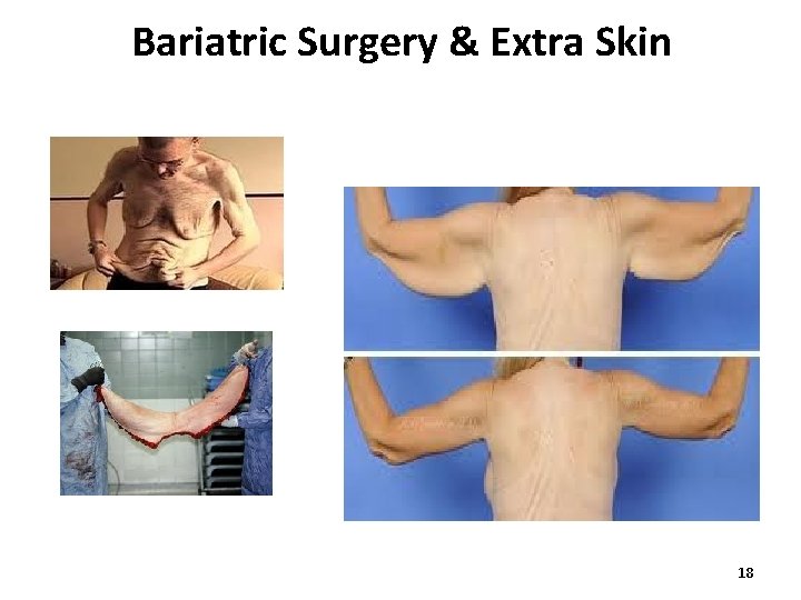 Bariatric Surgery & Extra Skin 18 