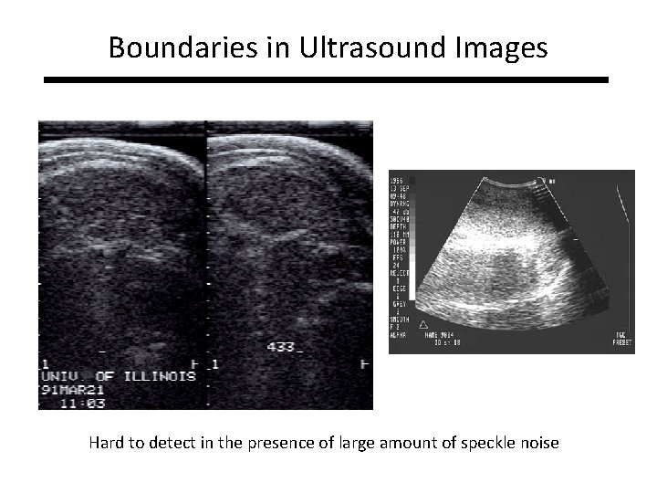 Boundaries in Ultrasound Images Hard to detect in the presence of large amount of Boundaries in Ultrasound Images Hard to detect in the presence of large amount of