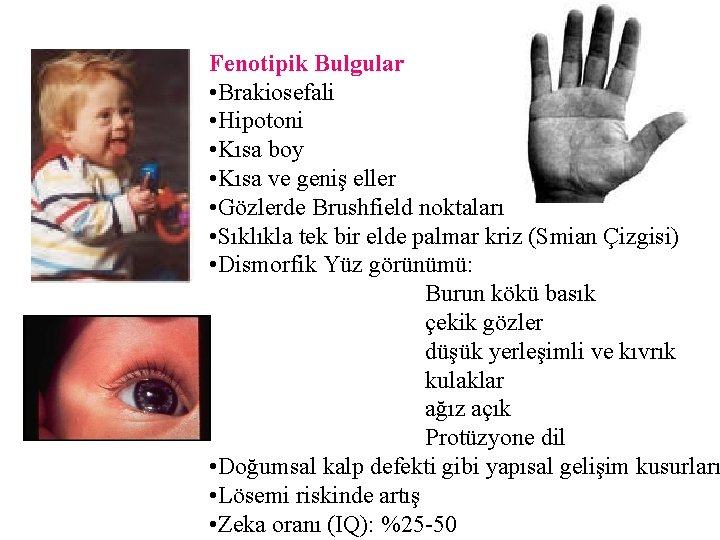 Fenotipik Bulgular • Brakiosefali • Hipotoni • Kısa boy • Kısa ve geniş eller