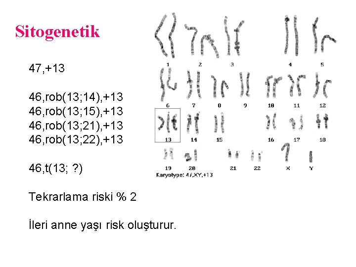 Sitogenetik 47, +13 46, rob(13; 14), +13 46, rob(13; 15), +13 46, rob(13; 21),