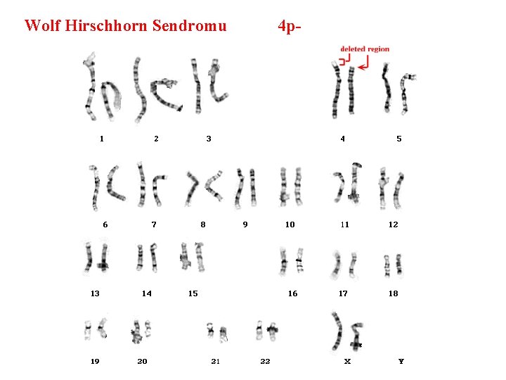 Wolf Hirschhorn Sendromu 4 p- 