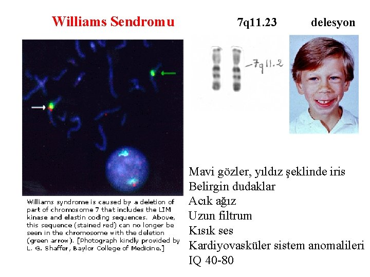 Williams Sendromu 7 q 11. 23 delesyon Mavi gözler, yıldız şeklinde iris Belirgin dudaklar
