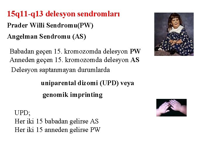15 q 11 -q 13 delesyon sendromları Prader Willi Sendromu(PW) Angelman Sendromu (AS) Babadan