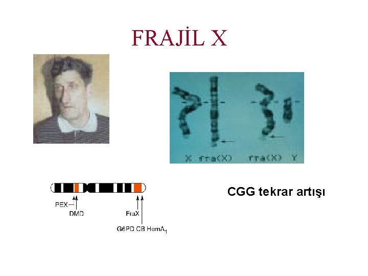 FRAJİL X CGG tekrar artışı 