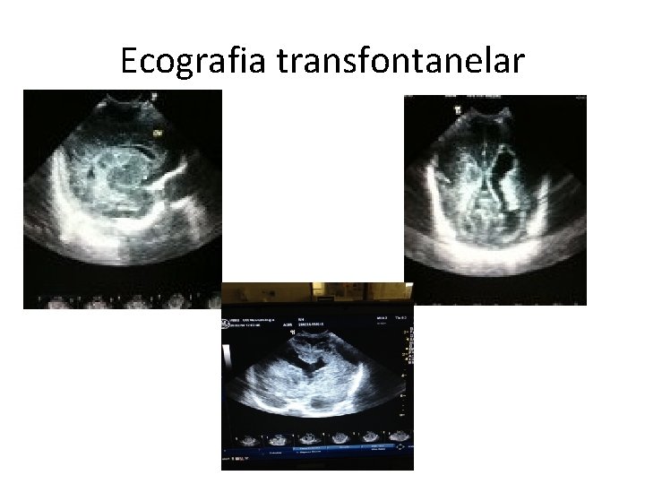 Ecografia transfontanelar 