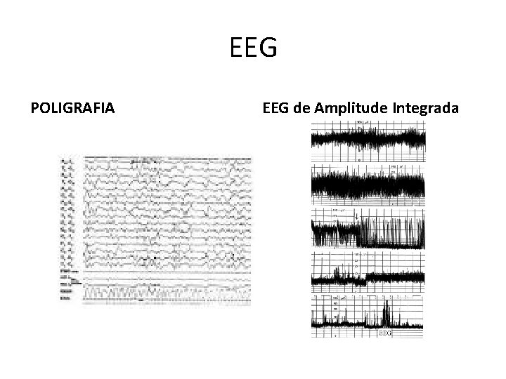 EEG POLIGRAFIA EEG de Amplitude Integrada 