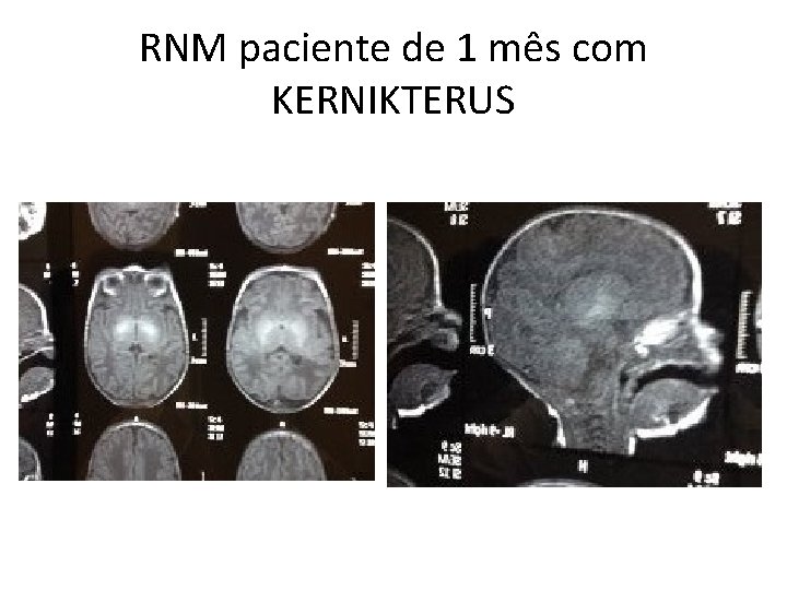 RNM paciente de 1 mês com KERNIKTERUS 