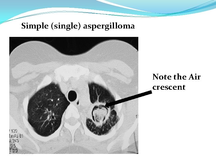 Simple (single) aspergilloma Note the Air crescent 