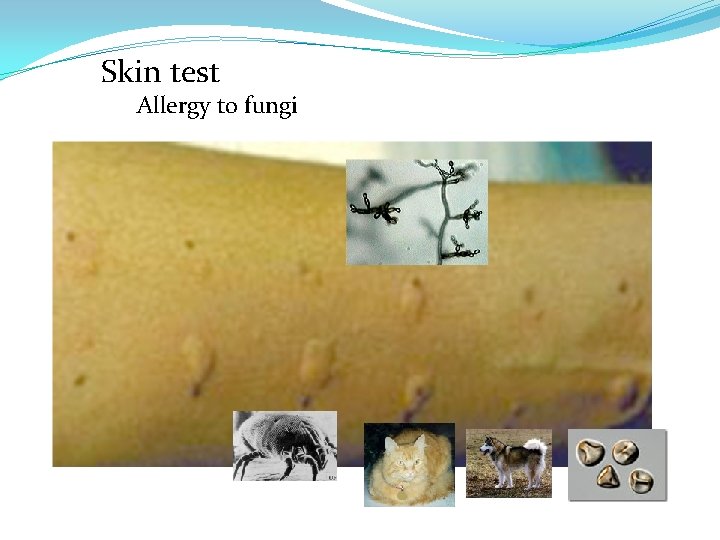 Skin test Allergy to fungi 