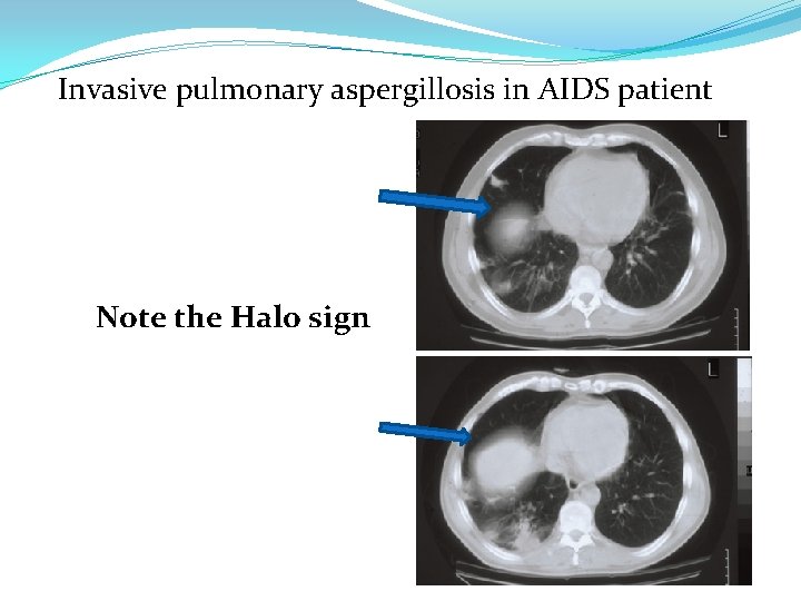 Invasive pulmonary aspergillosis in AIDS patient Note the Halo sign 