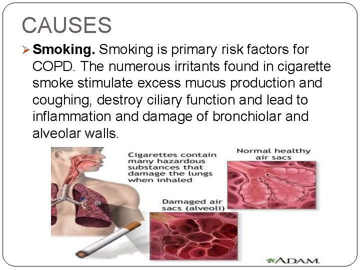 CAUSES Smoking is primary risk factors for COPD. The numerous irritants found in cigarette