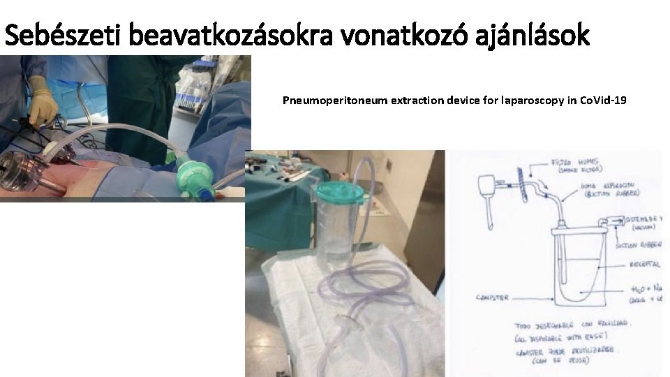 Sebészeti beavatkozásokra vonatkozó ajánlások Pneumoperitoneum extraction device for laparoscopy in Co. Vid-19 