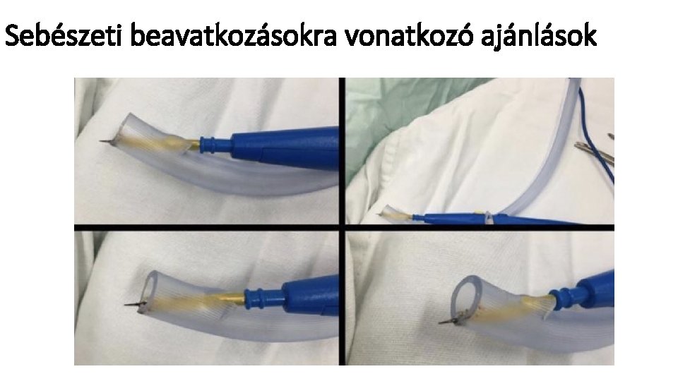 Sebészeti beavatkozásokra vonatkozó ajánlások 