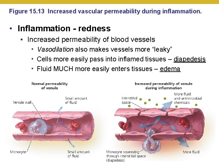 Figure 15. 13 Increased vascular permeability during inflammation. • Inflammation - redness • Increased