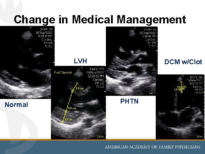 Change in Medical Management LVH Normal DCM w/Clot PHTN 