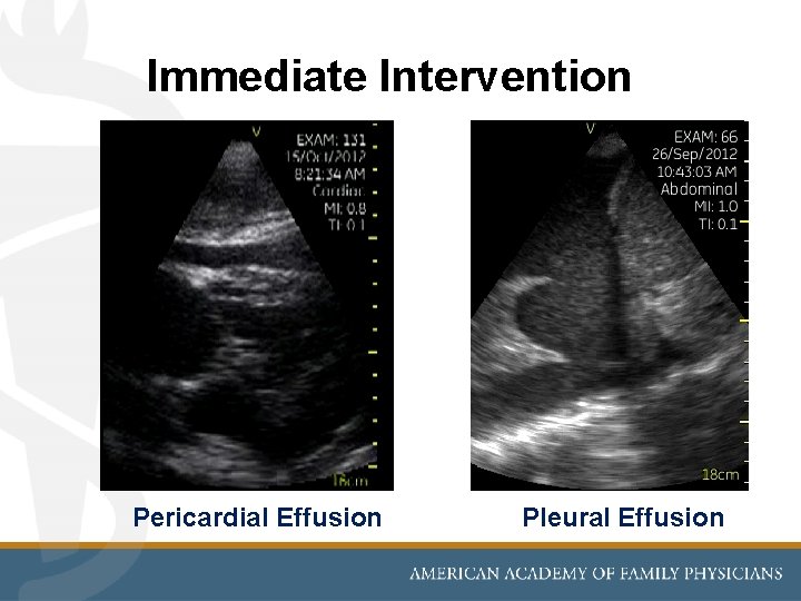 Immediate Intervention Pericardial Effusion Pleural Effusion 