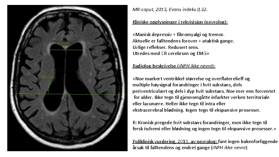 MR-caput, 2013, Evans indeks 0, 32. Kliniske opplysninger i rekvisisjon (nevrolog): «Manisk depressiv +