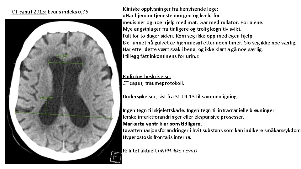 CT-caput 2015: Evans indeks 0, 35 Kliniske opplysninger fra henvisende lege: «Har hjemmetjeneste morgen