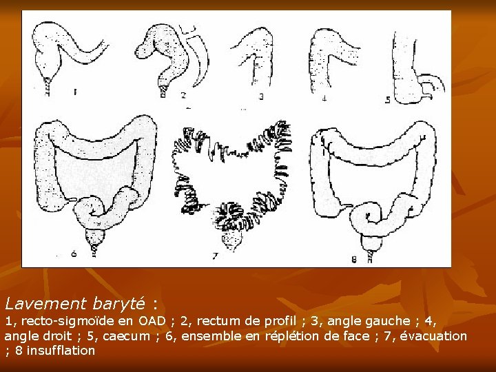Lavement baryté : 1, recto-sigmoïde en OAD ; 2, rectum de profil ; 3,