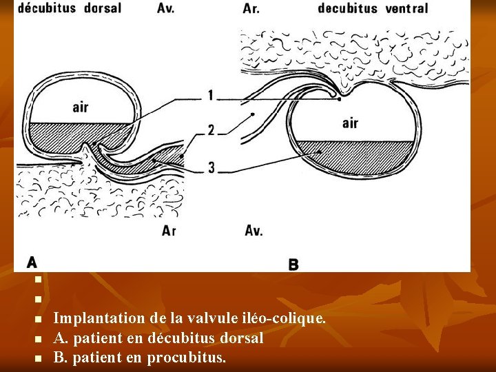 n n n Implantation de la valvule iléo-colique. A. patient en décubitus dorsal B.