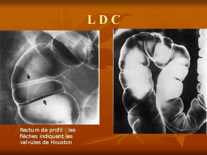 LDC Rectum de profil : les flèches indiquent les valvules de Houston 