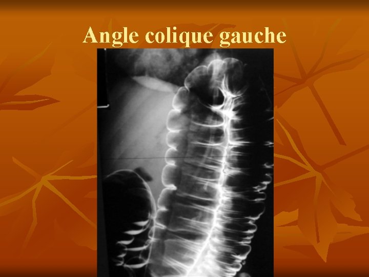 Angle colique gauche 