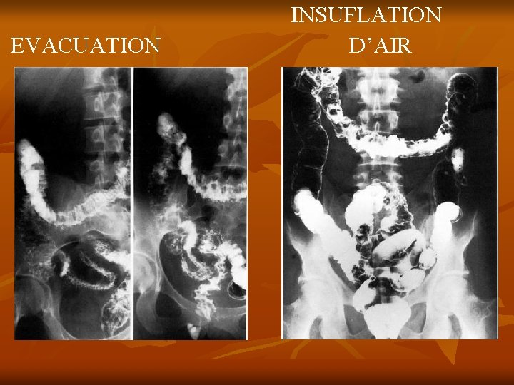 EVACUATION INSUFLATION D’AIR 