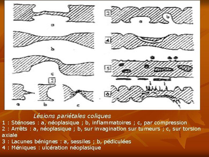 Lésions pariétales coliques 1 : Sténoses : a, néoplasique ; b, inflammatoires ; c,