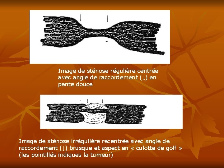 Image de sténose régulière centrée avec angle de raccordement (↓) en pente douce Image