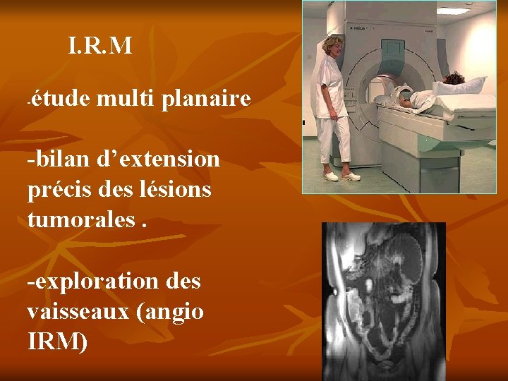 I. R. M - étude multi planaire -bilan d’extension précis des lésions tumorales. -exploration