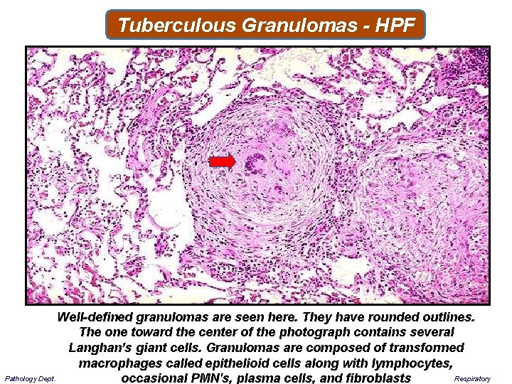 Tuberculous Granulomas - HPF Well-defined granulomas are seen here. They have rounded outlines. The