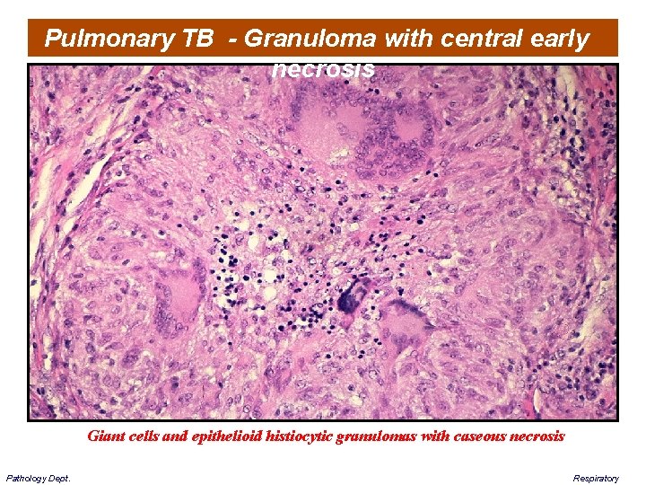Pulmonary TB - Granuloma with central early necrosis Giant cells and epithelioid histiocytic granulomas
