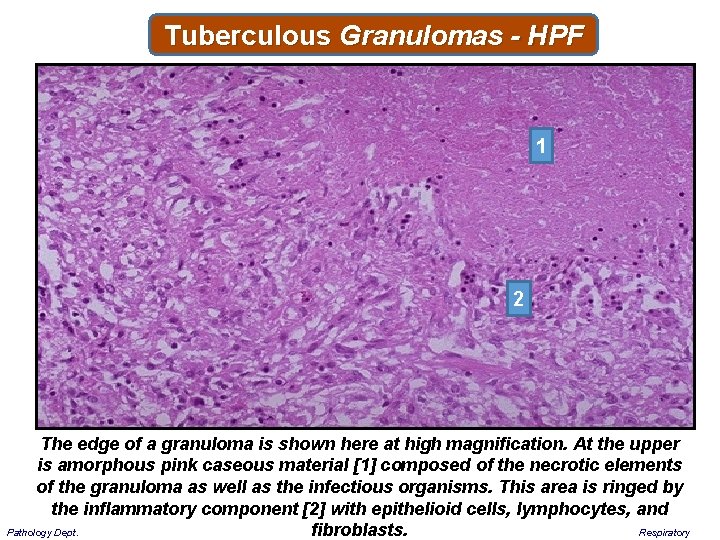 Tuberculous Granulomas - HPF 1 2 The edge of a granuloma is shown here