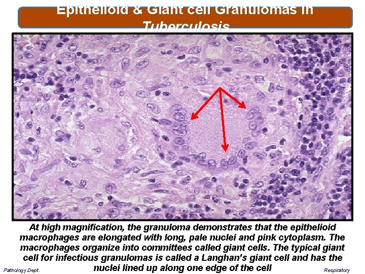 Epithelioid & Giant cell Granulomas in Tuberculosis At high magnification, the granuloma demonstrates that