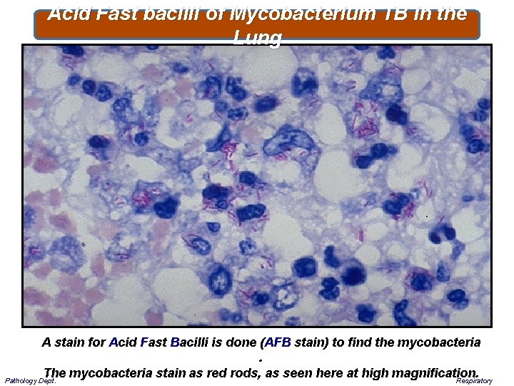 Acid Fast bacilli of Mycobacterium TB in the Lung A stain for Acid Fast