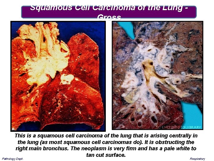 Squamous Cell Carcinoma of the Lung Gross This is a squamous cell carcinoma of