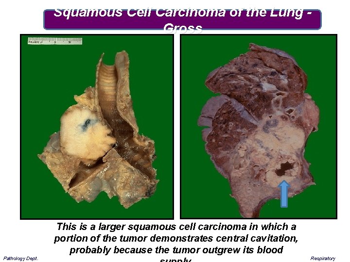 Squamous Cell Carcinoma of the Lung Gross This is a larger squamous cell carcinoma