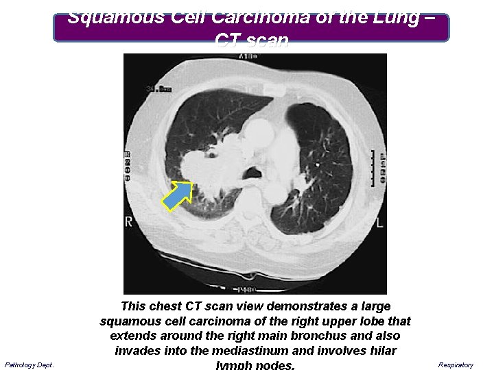 Squamous Cell Carcinoma of the Lung – CT scan Pathology Dept. This chest CT