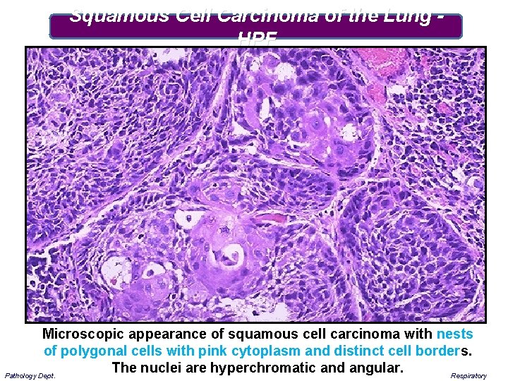 Squamous Cell Carcinoma of the Lung HPF Microscopic appearance of squamous cell carcinoma with