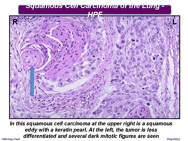 R Squamous Cell Carcinoma of the Lung HPF L In this squamous cell carcinoma