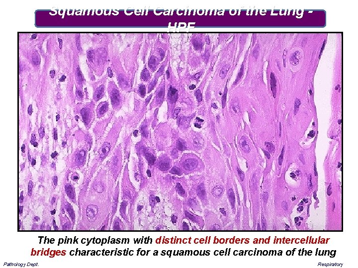 Squamous Cell Carcinoma of the Lung HPF The pink cytoplasm with distinct cell borders