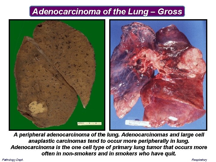 Adenocarcinoma of the Lung – Gross A peripheral adenocarcinoma of the lung. Adenocarcinomas and