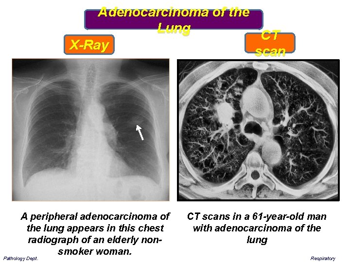 Adenocarcinoma of the Lung CT X-Ray scan A peripheral adenocarcinoma of the lung appears